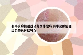 有牛皮癣能通过公务员体检吗 有牛皮癣能通过公务员体检吗女