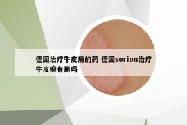 德国治疗牛皮癣的药 德国sorion治疗牛皮癣有用吗