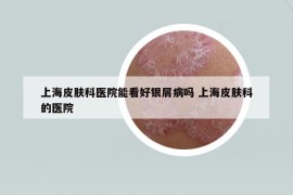 上海皮肤科医院能看好银屑病吗 上海皮肤科的医院