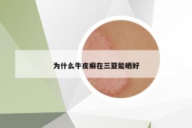 为什么牛皮癣在三亚能晒好