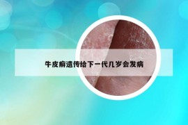 牛皮癣遗传给下一代几岁会发病