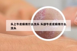 头上牛皮癣用什么洗头 头部牛皮皮癣用什么洗头
