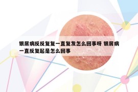 银屑病反反复复一直复发怎么回事呀 银屑病一直反复起是怎么回事
