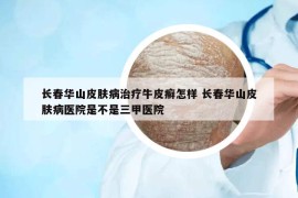 长春华山皮肤病治疗牛皮癣怎样 长春华山皮肤病医院是不是三甲医院