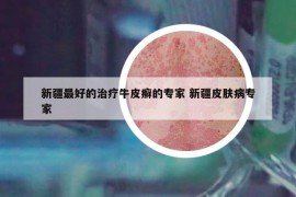 新疆最好的治疗牛皮癣的专家 新疆皮肤病专家