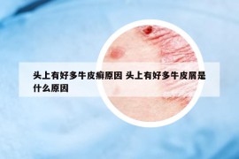 头上有好多牛皮癣原因 头上有好多牛皮屑是什么原因