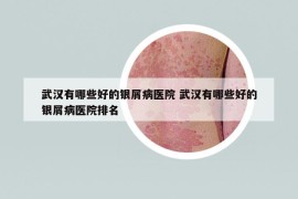 武汉有哪些好的银屑病医院 武汉有哪些好的银屑病医院排名