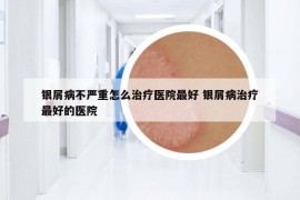 银屑病不严重怎么治疗医院最好 银屑病治疗最好的医院
