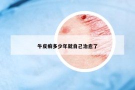 牛皮癣多少年就自己治愈了