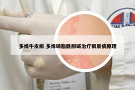 多烯牛皮癣 多烯磷脂酰胆碱治疗银屑病原理