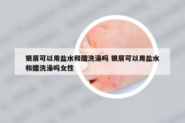 银屑可以用盐水和醋洗澡吗 银屑可以用盐水和醋洗澡吗女性