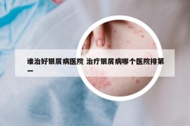 谁治好银屑病医院 治疗银屑病哪个医院排第一