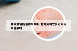 曲安奈德能治银屑病吗 他克莫司软膏可以治银屑病吗