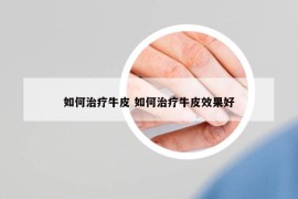 如何治疗牛皮 如何治疗牛皮效果好