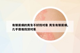 有银屑病的男生不好找对象 男生有银屑病,几乎很难找到对象