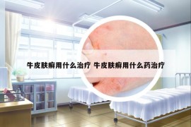 牛皮肤癣用什么治疗 牛皮肤癣用什么药治疗