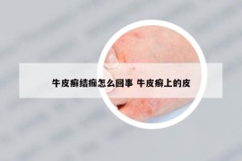 牛皮癣结痂怎么回事 牛皮癣上的皮