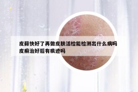 皮藓快好了再做皮肤活检能检测出什么病吗 皮癣治好后有痕迹吗