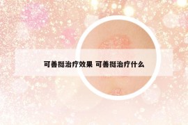 可善挺治疗效果 可善挺治疗什么