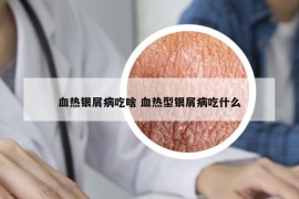 血热银屑病吃啥 血热型银屑病吃什么