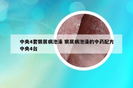 中央4套银屑病泡澡 银屑病泡澡的中药配方中央4台