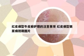 红皮病型牛皮癣护理的注意事项 红皮病型银屑病初期图片