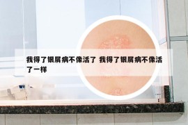 我得了银屑病不像活了 我得了银屑病不像活了一样