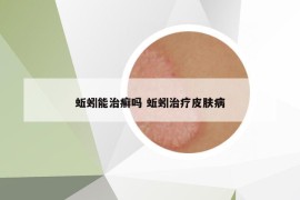 蚯蚓能治癣吗 蚯蚓治疗皮肤病