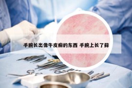 手腕长出像牛皮癣的东西 手腕上长了藓