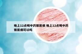 晚上12点喝中药银屑病 晚上12点喝中药银屑病可以吗