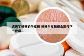 遗传了爸爸的牛皮癣 爸爸牛皮肤癣会遗传下一代吗