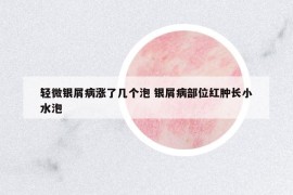 轻微银屑病涨了几个泡 银屑病部位红肿长小水泡