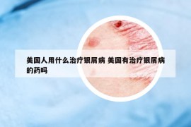 美国人用什么治疗银屑病 美国有治疗银屑病的药吗