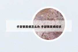 手背银屑病怎么办 手部银屑病症状