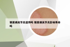 银屑病关节炎遗传吗 银屑病关节炎影响寿命吗
