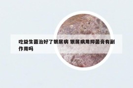 吃益生菌治好了银屑病 银屑病用抑菌膏有副作用吗