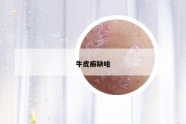 牛皮癣缺啥