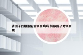 转因子口服液能治银屑病吗 转移因子对银屑病