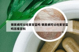 银屑病可以吃紫甘蓝吗 银屑病可以吃紫甘蓝吗百度百科