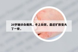 20岁确诊白癜风，手上白斑，最近扩散变大了一些，