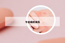 牛皮癣的来历