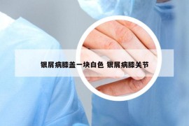 银屑病膝盖一块白色 银屑病膝关节