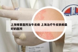 上海哪里医院治牛皮癣 上海治疗牛皮肤癣最好的医院