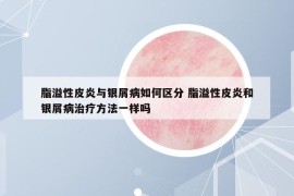 脂溢性皮炎与银屑病如何区分 脂溢性皮炎和银屑病治疗方法一样吗