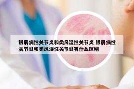 银屑病性关节炎和类风湿性关节炎 银屑病性关节炎和类风湿性关节炎有什么区别