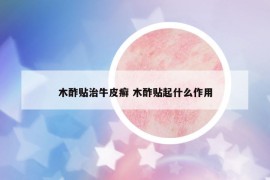 木酢贴治牛皮癣 木酢贴起什么作用