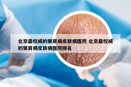 北京最权威的银屑病皮肤病医院 北京最权威的银屑病皮肤病医院排名