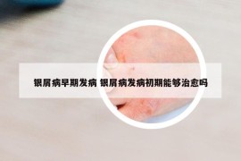 银屑病早期发病 银屑病发病初期能够治愈吗