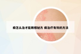 癣怎么治才能断根秘方 癣治疗有效的方法