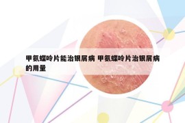 甲氨蝶呤片能治银屑病 甲氨蝶呤片治银屑病的用量